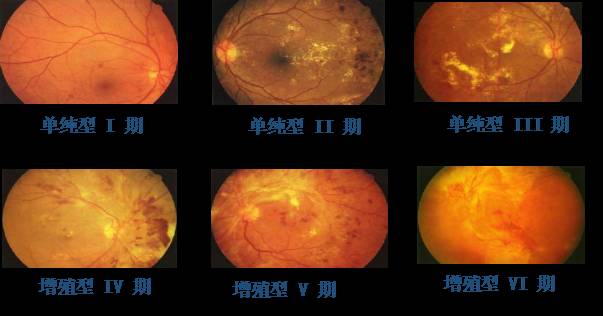 糖尿病性视网膜病变如何?